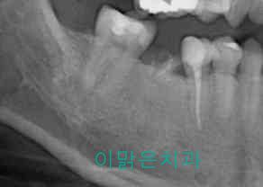 [임플란트] 임플란트