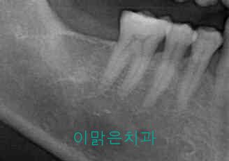 [임플란트] 임플란트
