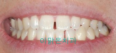 [치아성형] 벌어진 앞니 치료