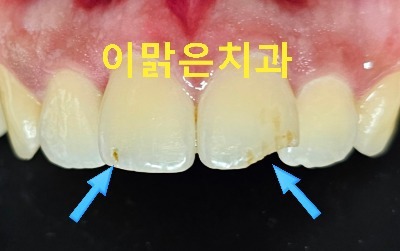 [보존치료, 앞니레진치료]  깨진 앞니 레진으로 치료