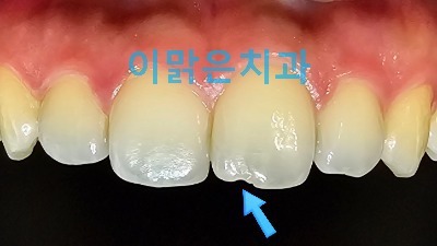 [보존치료, 심미치료]  깨진 앞니 레진 치료