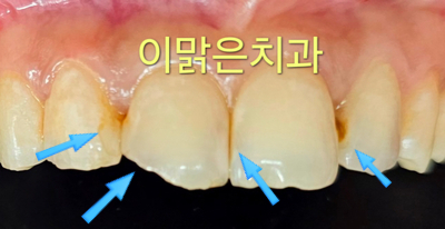 [치아성형, 심미보철치료] 앞니 충치, 파절, 변색 올세라믹치료
