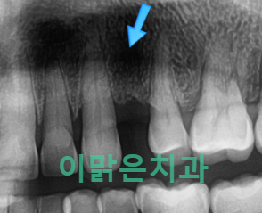 [임플란트] 치아가 하나 빠졌을 때 치료방법, 임플란트