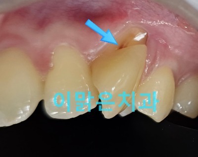  [보존치료] 치경부 마모,  치근 패임 치료