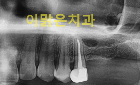  〔 임플란트 〕 상악동 거상술과 함께 임플란트 식립