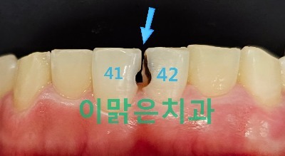  [보존치료, 심미보철] 아래 앞니 충치 레진 크라운 