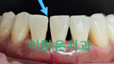 [보존치료, 심미치료]  치아사이가 벌어진 아래 앞니 레진 치료