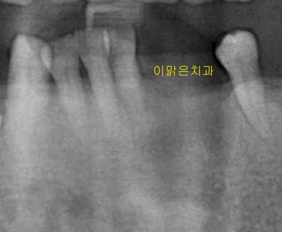  [임플란트] 임플란트