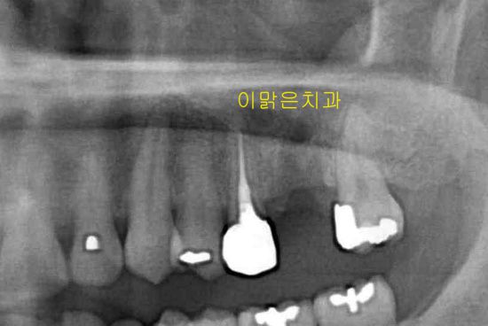 [임플란트] 임플란트