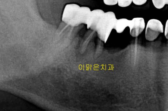 [임플란트] 임플란트