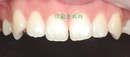  [치아성형] 벌어진 앞니 레진치료