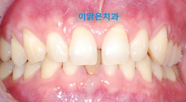  [치아성형, 심미보철]  벌어진 앞니 라미네이트 치료
