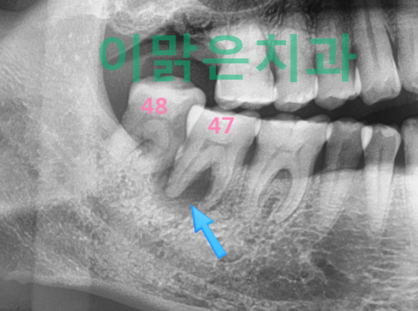 [임플란트] 아래 어금니 임플란트 치료과정