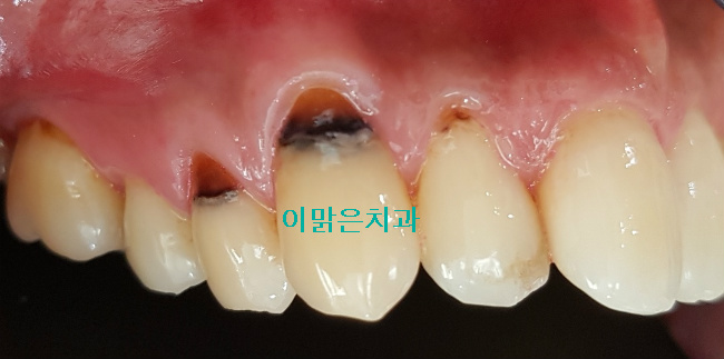 [충치치료] 치경부 우식 레진치료
