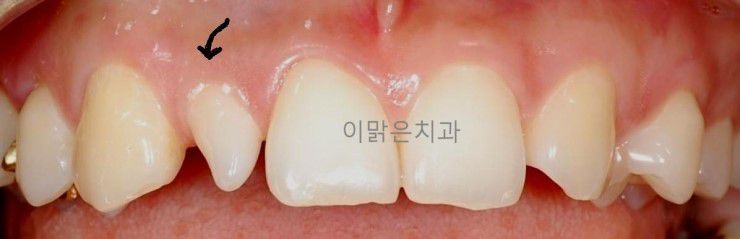 [치아성형] 라미네이트 치아성형