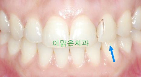 [일반치과치료] 앞니 레진 치료
