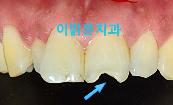  [보존치료, 앞니레진치료]  깨진 앞니 레진 치료