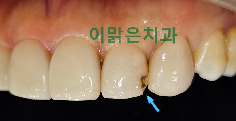 [심미보철]  앞니 라미네이트 재치료 