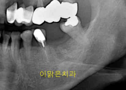  [임플란트] 임플란트