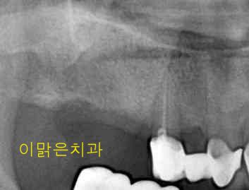  [임플란트] 임플란트