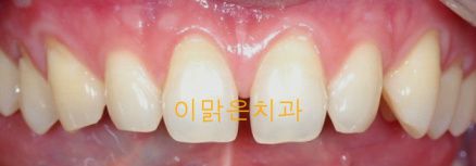 [치아성형] 라미네이트 치아성형, 벌어진 앞니치료