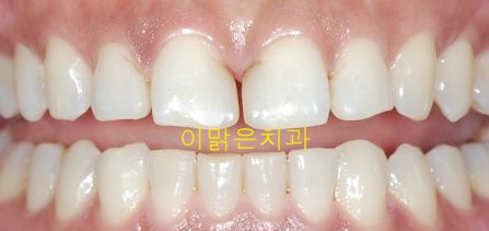 [치아성형] 벌어진 앞니