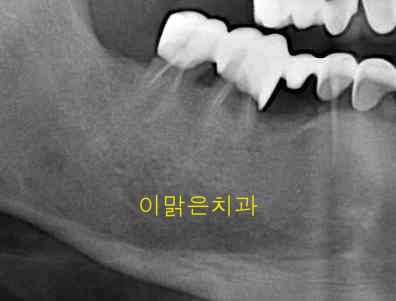 [임플란트] 임플란트