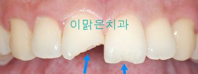 [치아성형] 파절된 앞니 치료