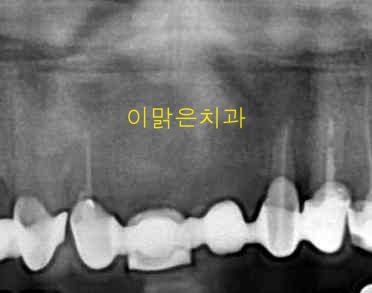  [임플란트] 임플란트