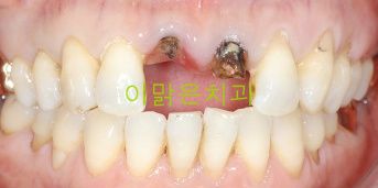 [보철치료] 많이 썩어서 부러진 앞니