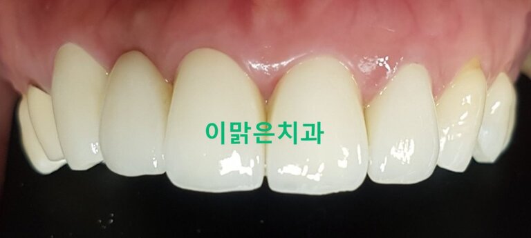 [치아성형, 심미보철]  앞니 올세라믹 보철