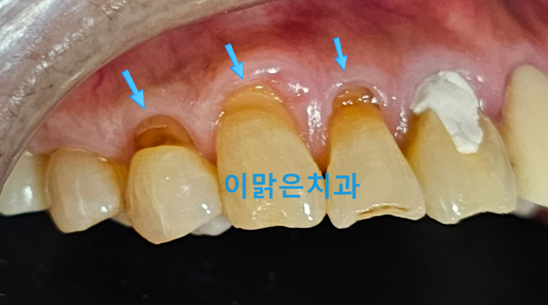 [심미보철] 치경부 마모가 심해지면