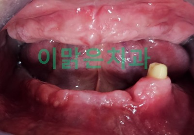 [보철치료]  틀니 치료
