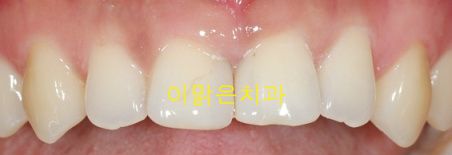 [치아성형] 앞니 올세라믹 보철 치료 및 잇몸성형