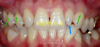 [심미보철] 작은 앞니 라미네이트 및 레진수복