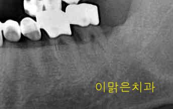 [임플란트] 임플란트