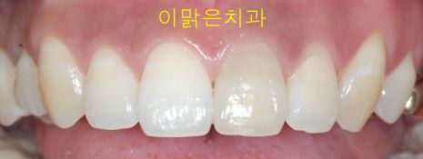 [심미보철]  심미보철