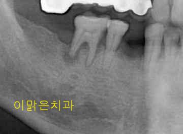 [임플란트] 임플란트와 보철치료