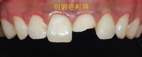 [보철치료] 파절된 앞니 치료