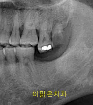  [임플란트] 임플란트