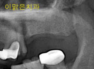 [임플란트] 임플란트