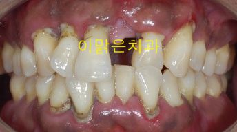 [보철치료,치주치료] 치주염으로 상실된 앞니 수복