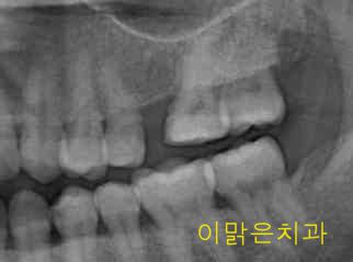   [임플란트] 임플란트