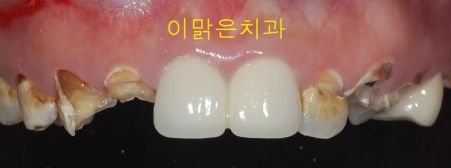 [심미보철] 충치가 심한 앞니 심미보철 치료