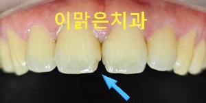 [보존치료, 앞니레진치료] 벌어진 앞니 레진으로 재치료