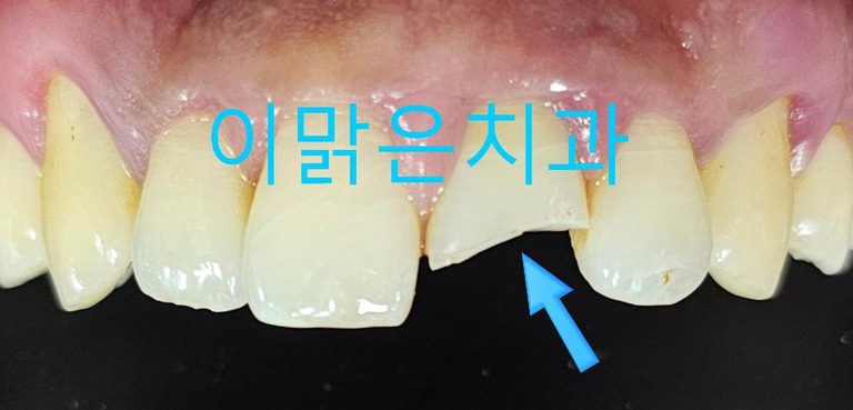  [심미보철]  앞니 파절 