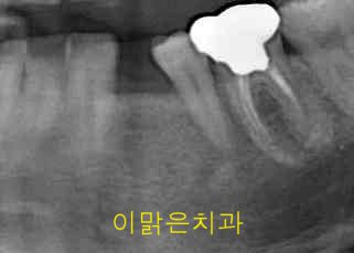 [임플란트] 임플란트