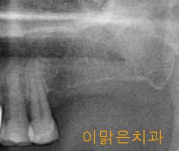[임플란트] 임플란트