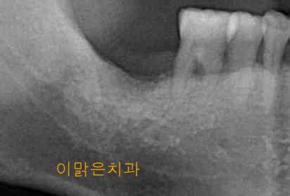 [임플란트] 임플란트