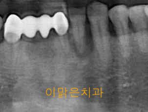 [임플란트] 임플란트